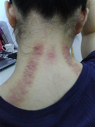 Gua sha as diagnosis purple sha with yellow ghosting..