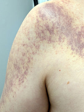 Sha marks from gua sha on shoulder showing extensive purple and reddish discoloration on light skin. Background is a neutral indoor setting.