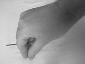 Moxibustion technique placing the floss